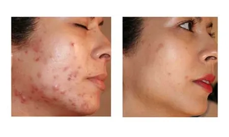 OM Botanicals - OM305 - Natural Acne Solution Kit - Face Wash, Moisturizer, And Acne/scar Treatment